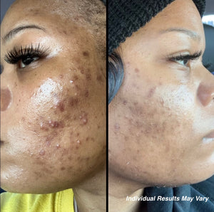 4 Week Acne Bootcamp